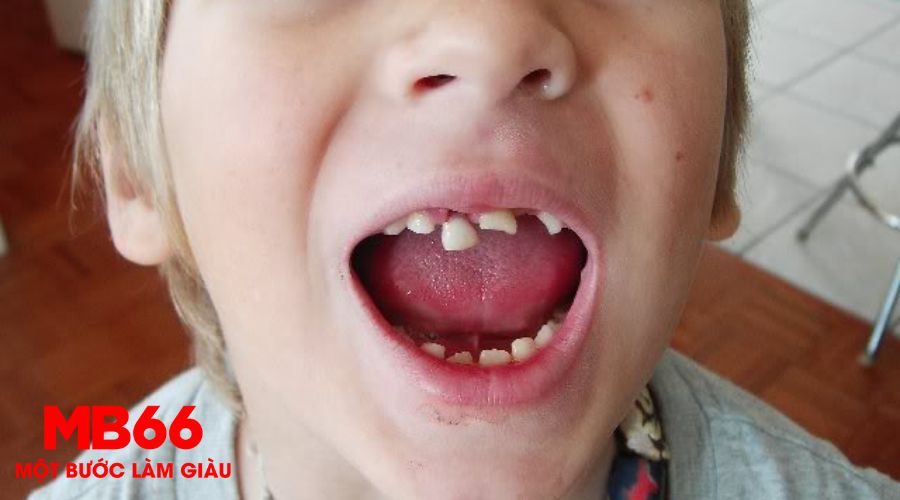 Mơ thấy rụng răng bị chảy máu và ý nghĩa